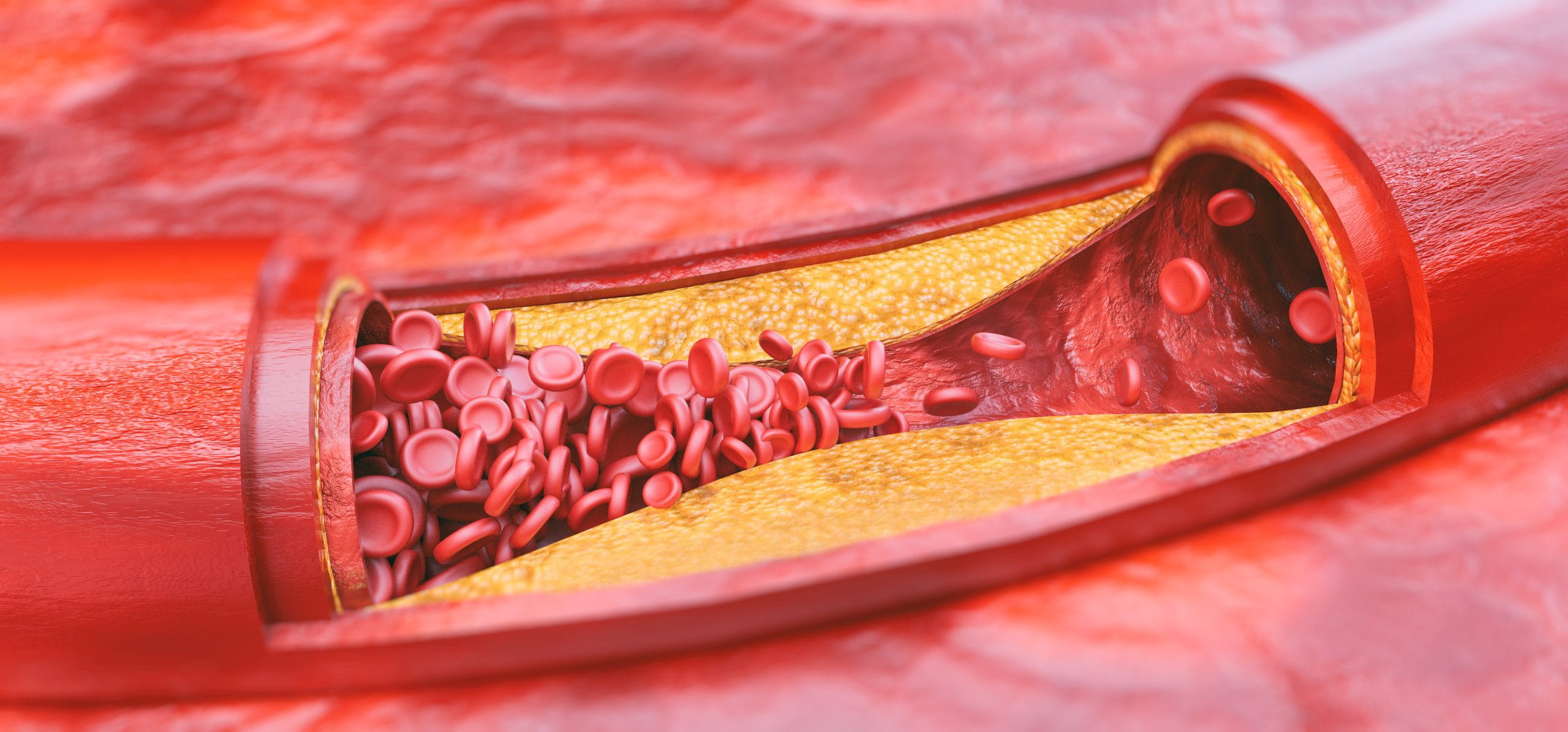 Atherosclerosis: The Invisible Risk Behind Strokes, Kidney Disease, and More—Why Early Screening Matters
